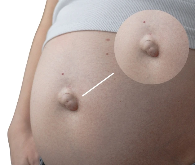 umbilical hernia